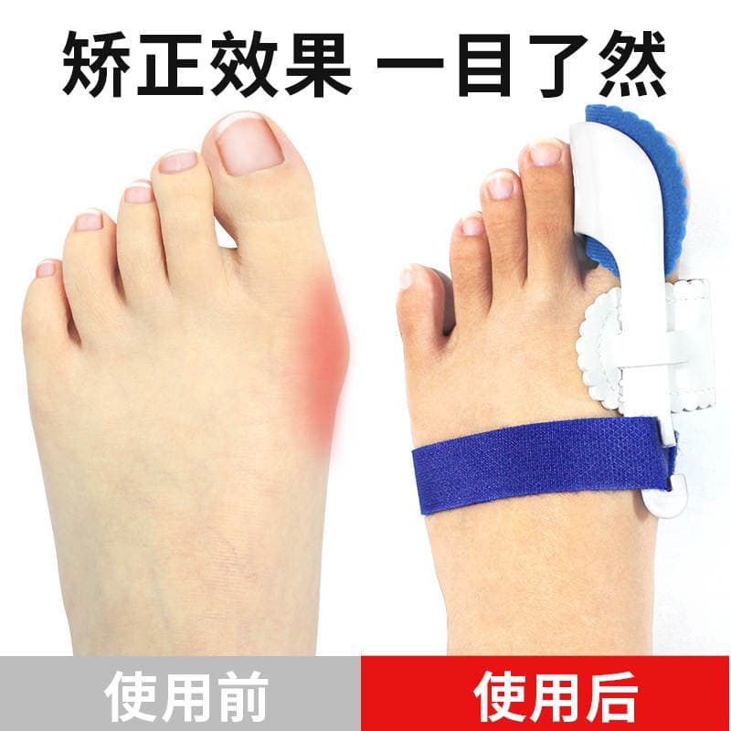 Bunion və barmaq deformasiyası korreksiyası üçün ayaq barmağı ayırıcı 3